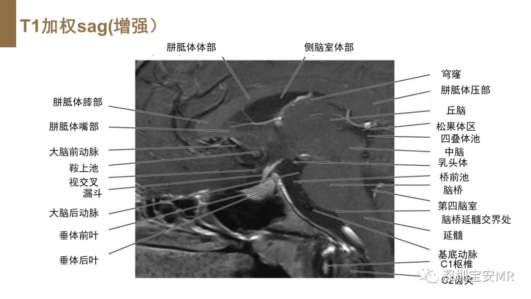 影像PPT - 【PPT】垂体磁共振影像解剖-23