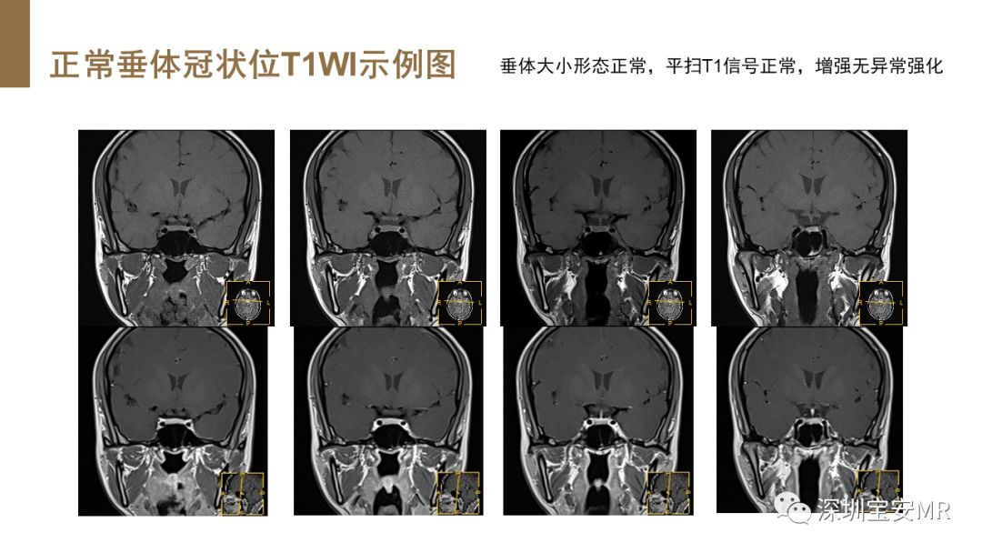 影像PPT - 【PPT】垂体磁共振影像解剖-24