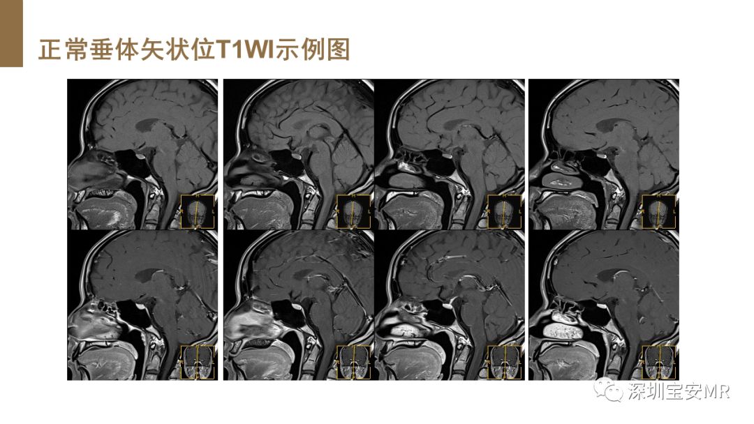 影像PPT - 【PPT】垂体磁共振影像解剖-25