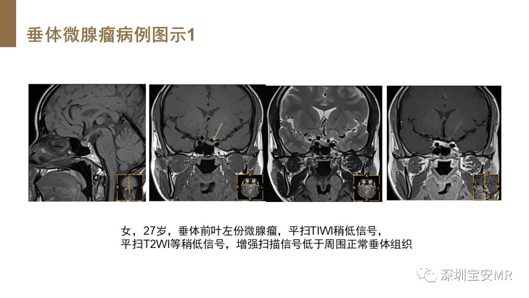 影像PPT - 【PPT】垂体磁共振影像解剖-26