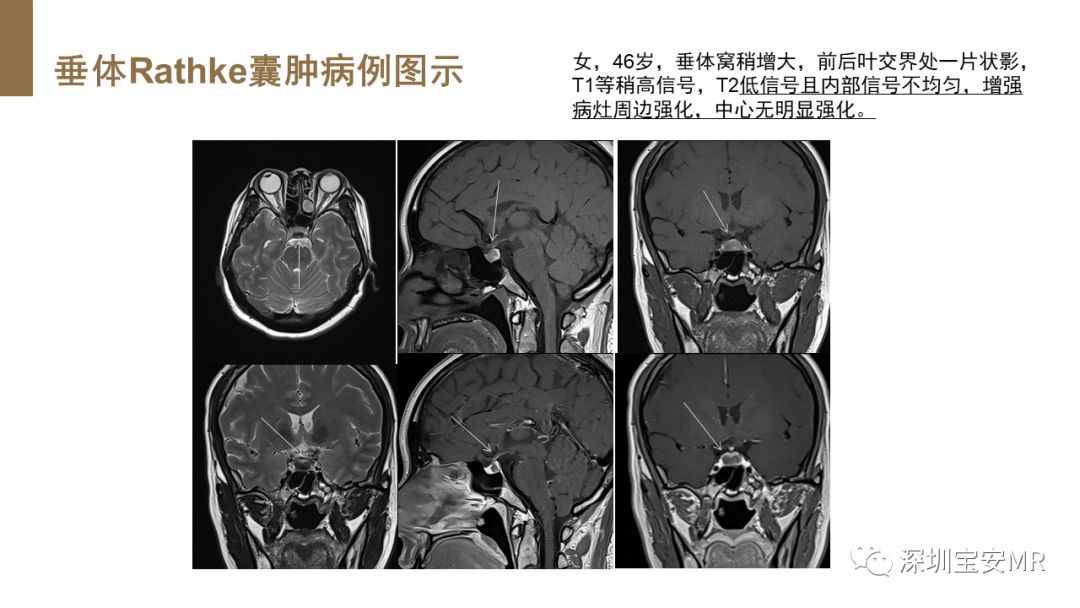 影像PPT - 【PPT】垂体磁共振影像解剖-30
