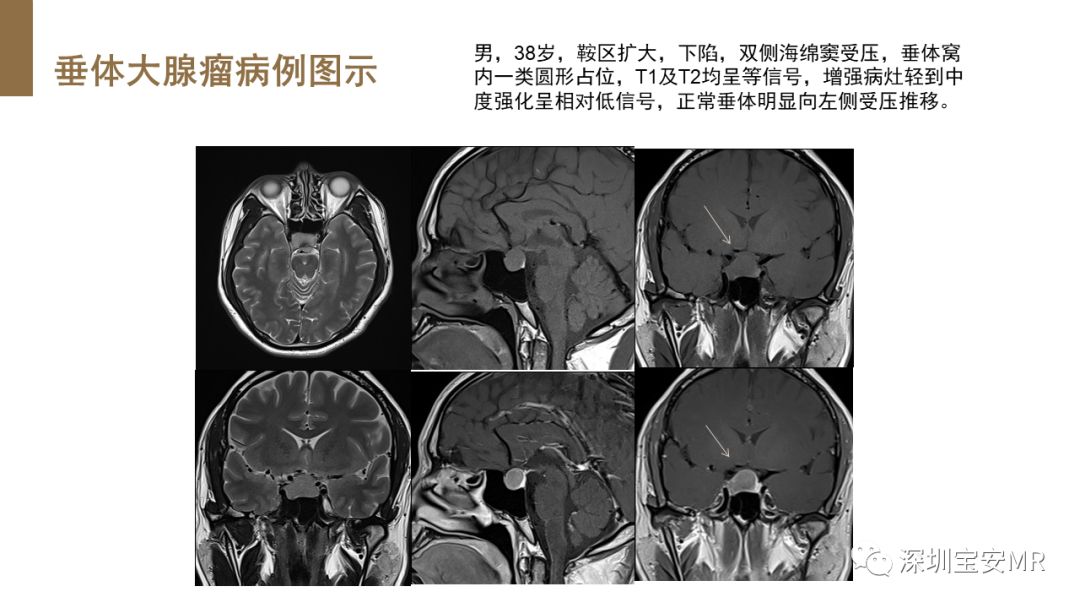 影像PPT - 【PPT】垂体磁共振影像解剖-29