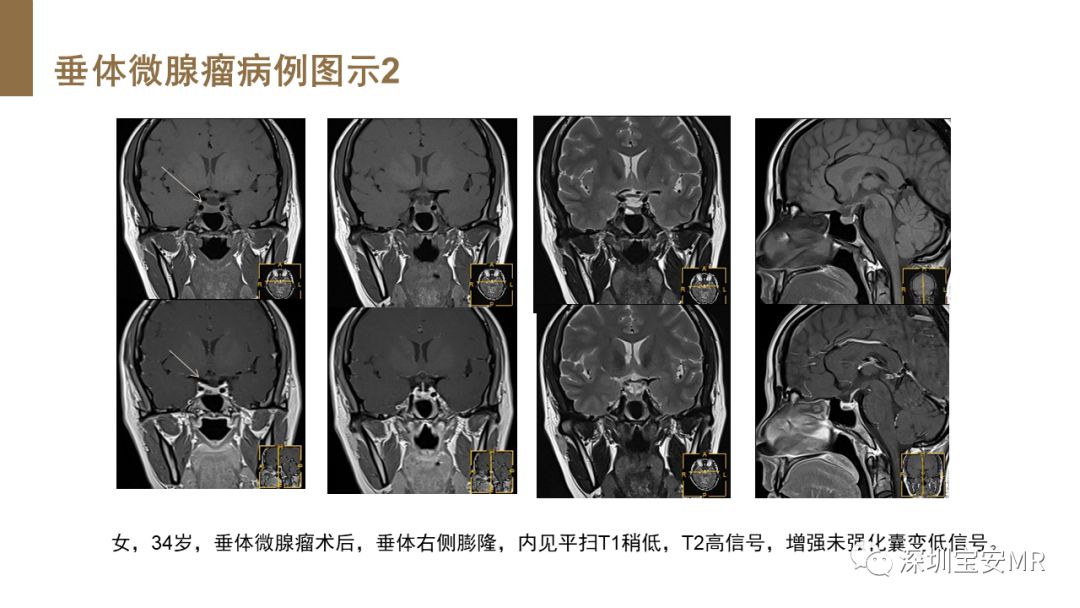 影像PPT - 【PPT】垂体磁共振影像解剖-27