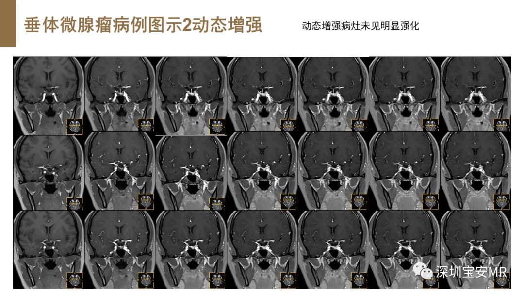 影像PPT - 【PPT】垂体磁共振影像解剖-28