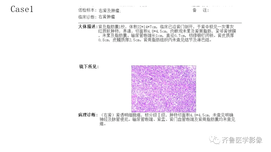 影像PPT - 【PPT】肾脏实性肿瘤-6