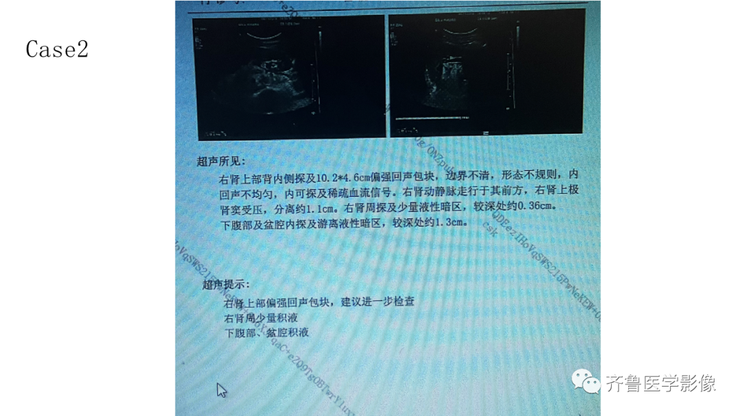 影像PPT - 【PPT】肾脏实性肿瘤-9