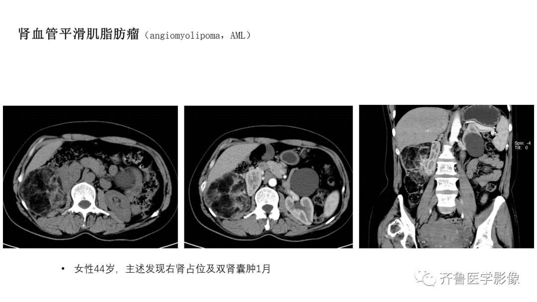 影像PPT - 【PPT】肾脏实性肿瘤-18