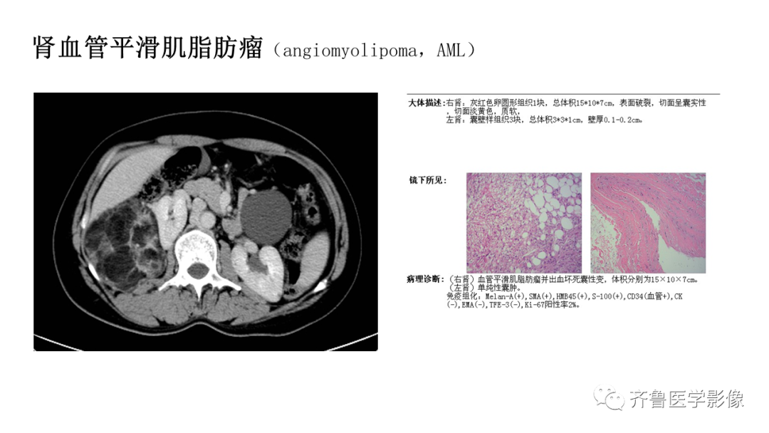 影像PPT - 【PPT】肾脏实性肿瘤-19
