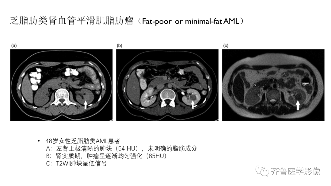 影像PPT - 【PPT】肾脏实性肿瘤-20