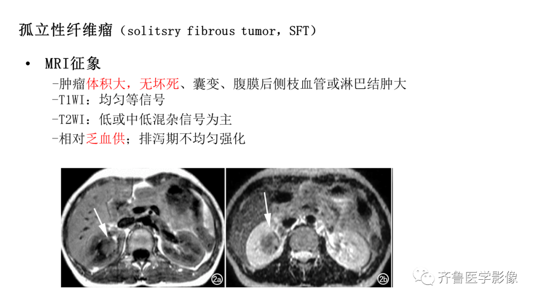 影像PPT - 【PPT】肾脏实性肿瘤-29