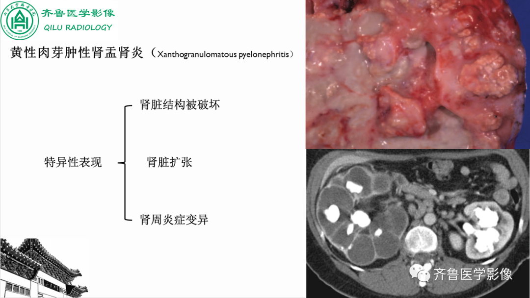 影像PPT - 【PPT】肾脏实性肿瘤-33