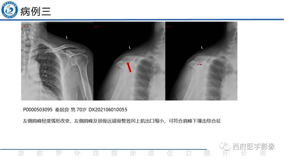 影像PPT - 【PPT】肩峰下撞击综合征影像表现-7