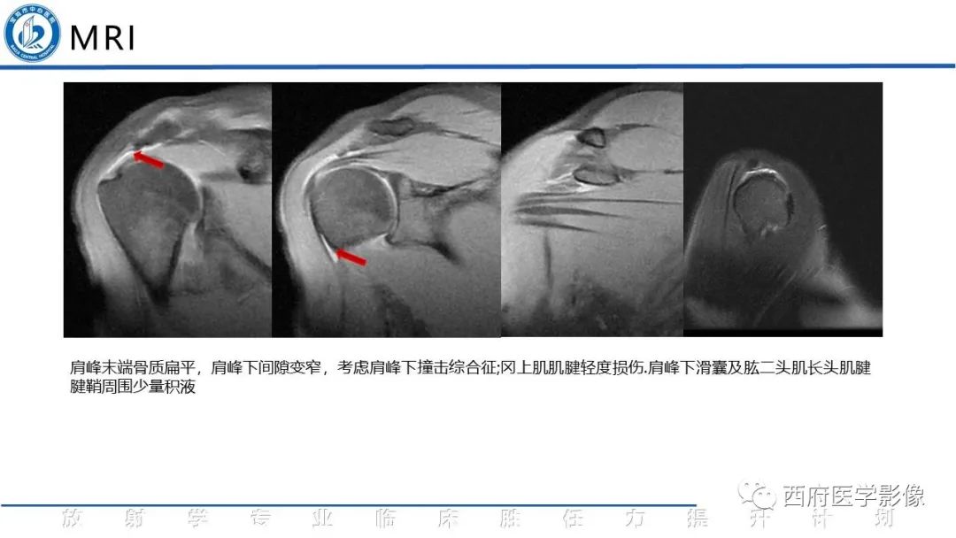 影像PPT - 【PPT】肩峰下撞击综合征影像表现-6