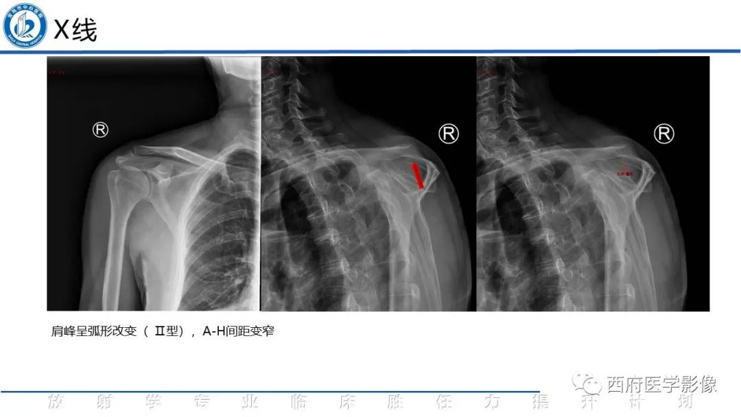 影像PPT - 【PPT】肩峰下撞击综合征影像表现-5