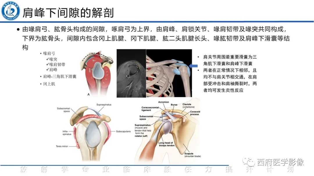 影像PPT - 【PPT】肩峰下撞击综合征影像表现-13