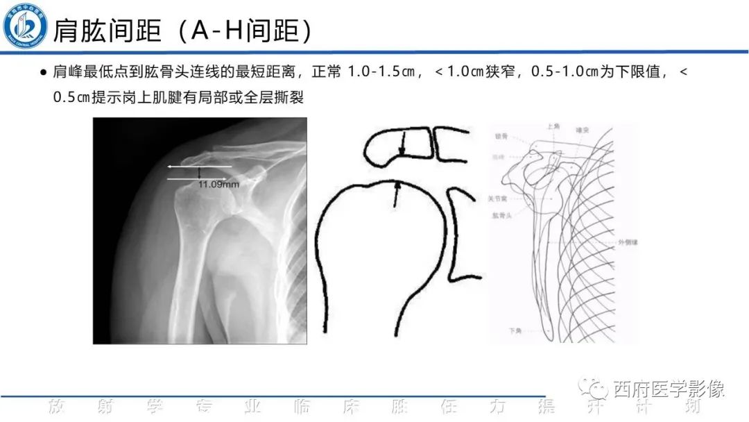 影像PPT - 【PPT】肩峰下撞击综合征影像表现-14