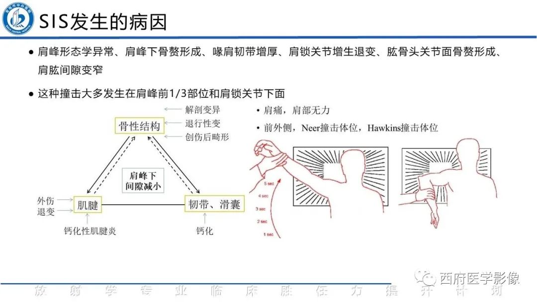影像PPT - 【PPT】肩峰下撞击综合征影像表现-15