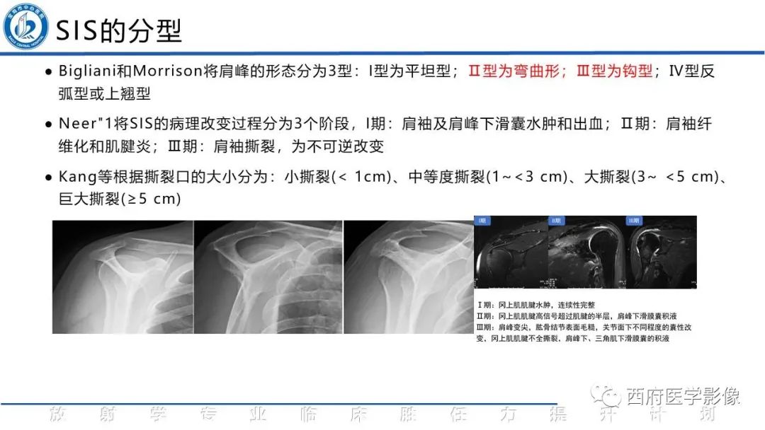 影像PPT - 【PPT】肩峰下撞击综合征影像表现-16