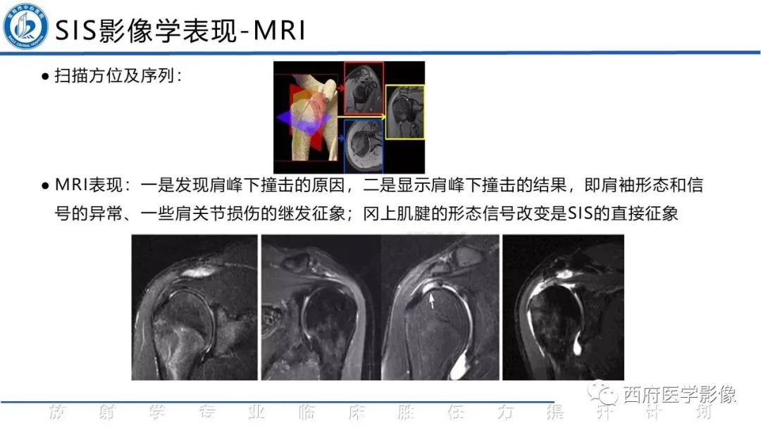 影像PPT - 【PPT】肩峰下撞击综合征影像表现-19