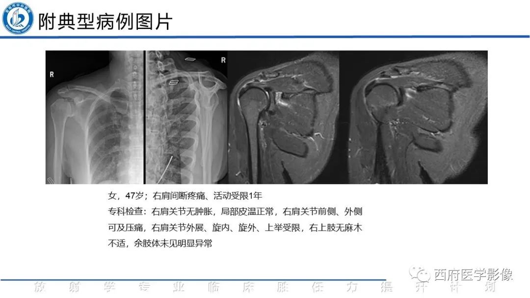 影像PPT - 【PPT】肩峰下撞击综合征影像表现-23