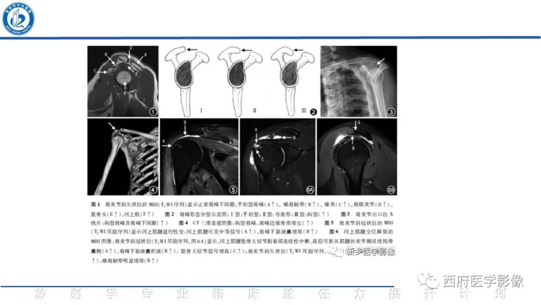 影像PPT - 【PPT】肩峰下撞击综合征影像表现-24