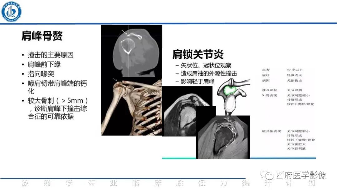 影像PPT - 【PPT】肩峰下撞击综合征影像表现-25