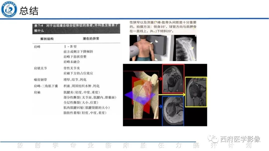 影像PPT - 【PPT】肩峰下撞击综合征影像表现-28