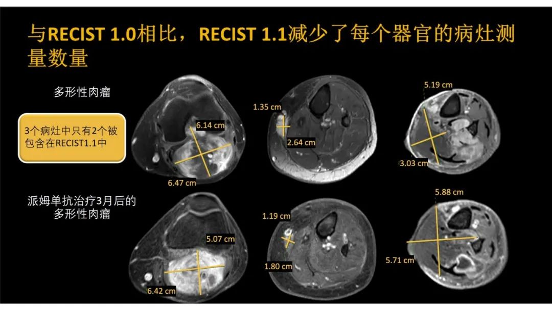 影像PPT - 【PPT】软组织肉瘤:评估治疗反应的影像学指南回顾-17