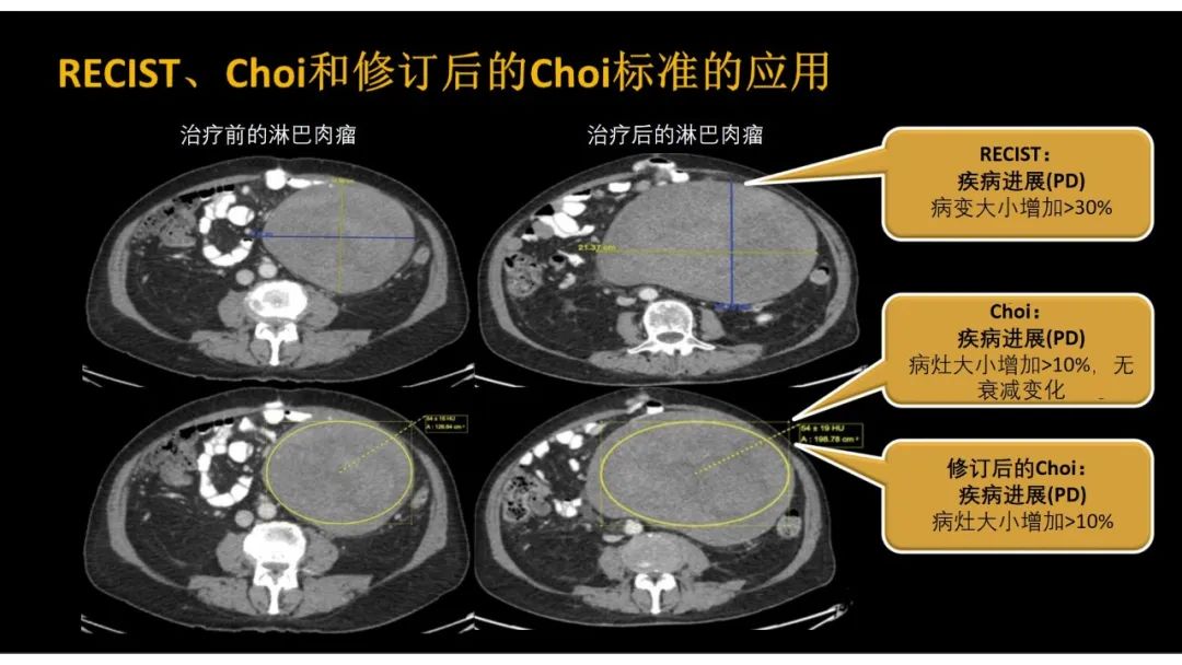 影像PPT - 【PPT】软组织肉瘤:评估治疗反应的影像学指南回顾-43