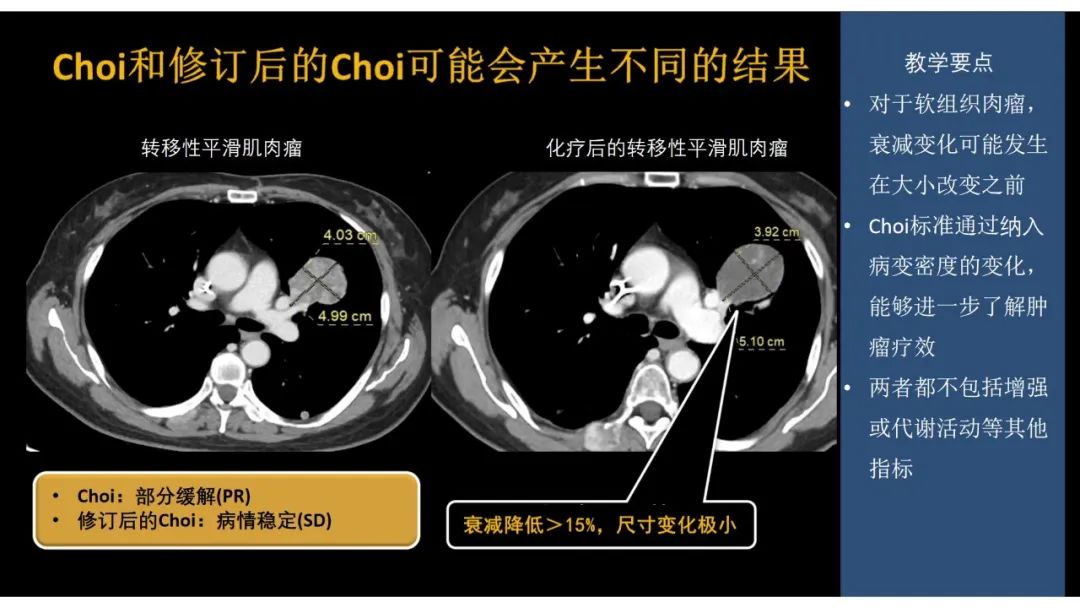 影像PPT - 【PPT】软组织肉瘤:评估治疗反应的影像学指南回顾-49