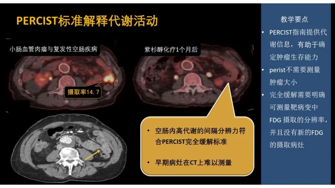 影像PPT - 【PPT】软组织肉瘤:评估治疗反应的影像学指南回顾-59