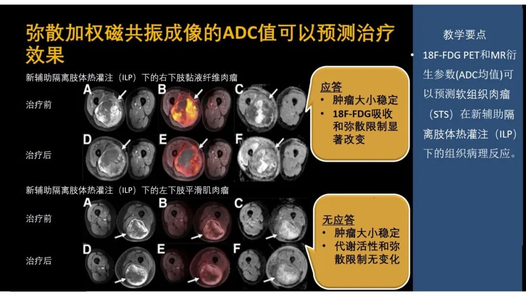 影像PPT - 【PPT】软组织肉瘤:评估治疗反应的影像学指南回顾-69