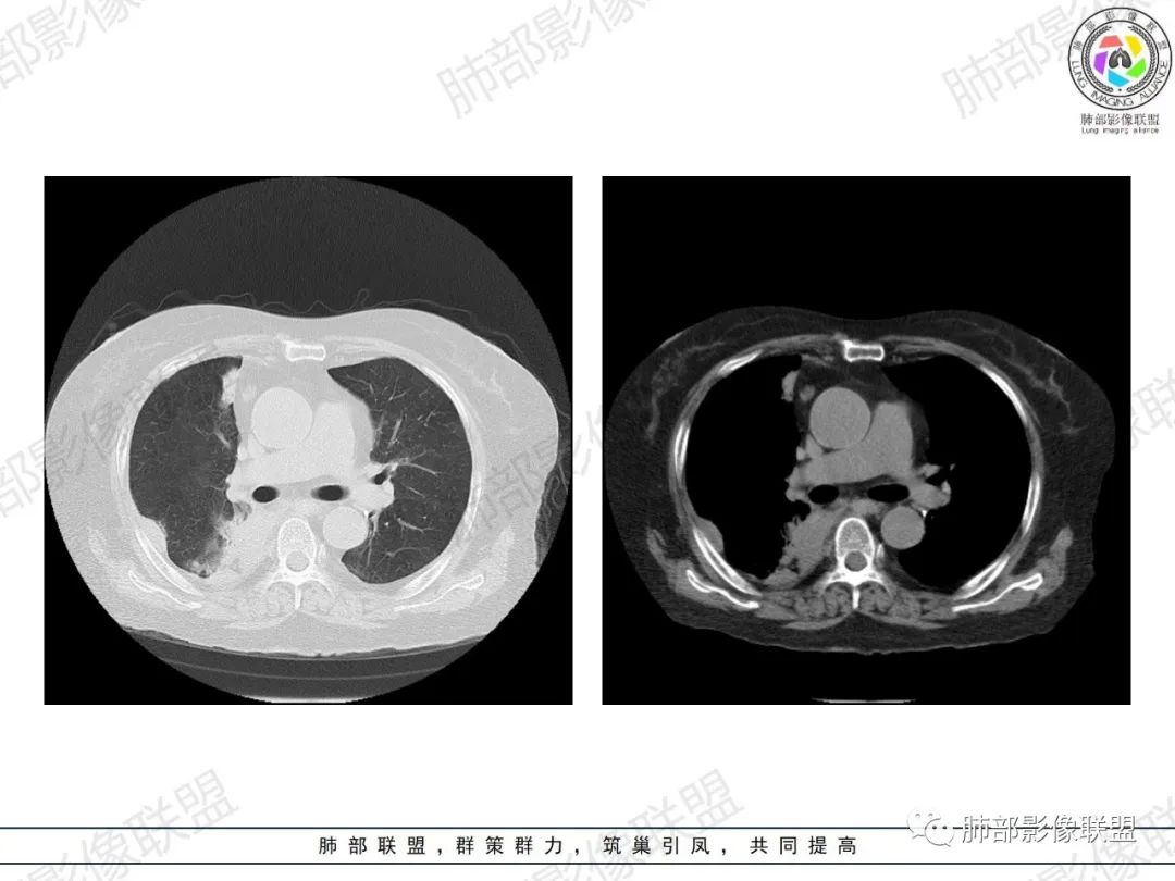 影像PPT - 【病例】肺部弥漫大B细胞淋巴瘤1例CT影像讨论-12 影像PPT - 【病例】肺部弥漫大B细胞淋巴瘤1例CT影像讨论-12
