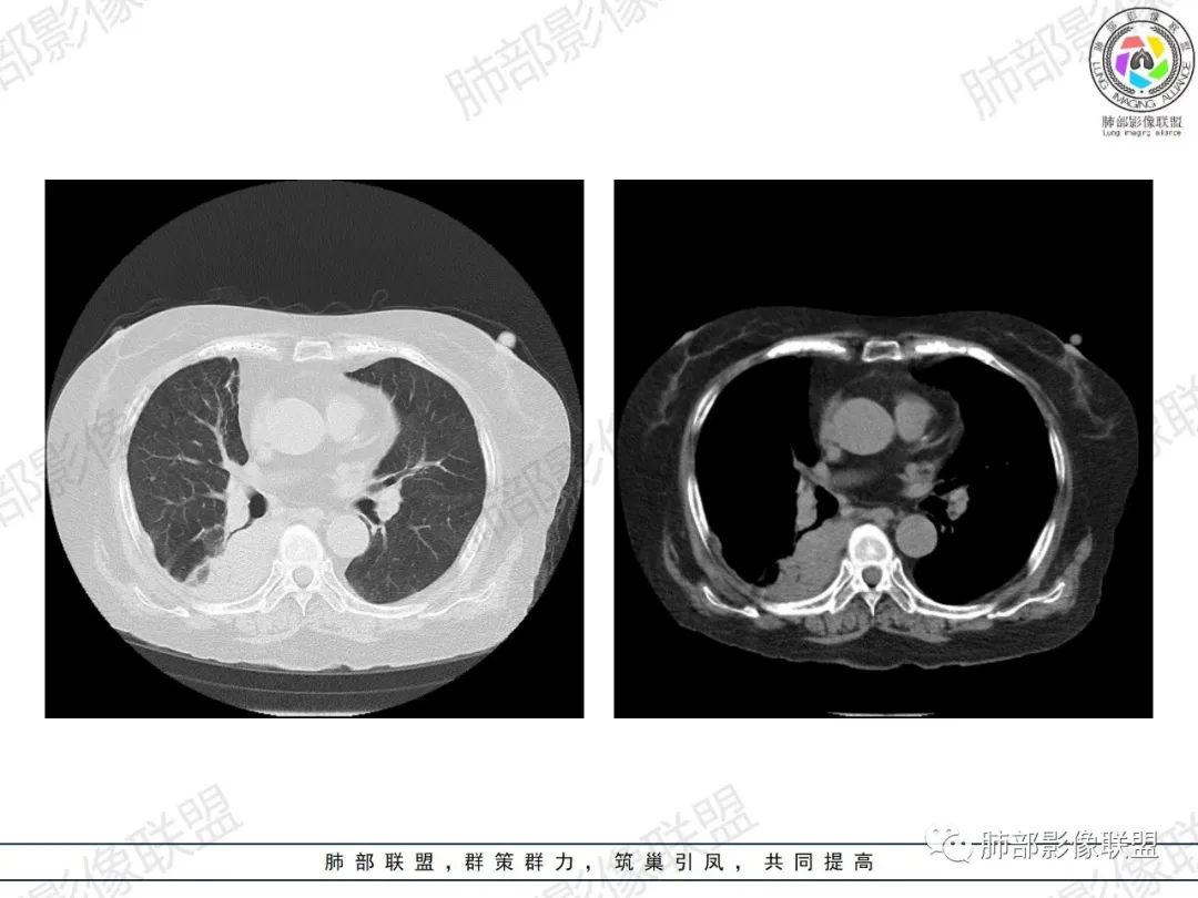 影像PPT - 【病例】肺部弥漫大B细胞淋巴瘤1例CT影像讨论-15 影像PPT - 【病例】肺部弥漫大B细胞淋巴瘤1例CT影像讨论-15