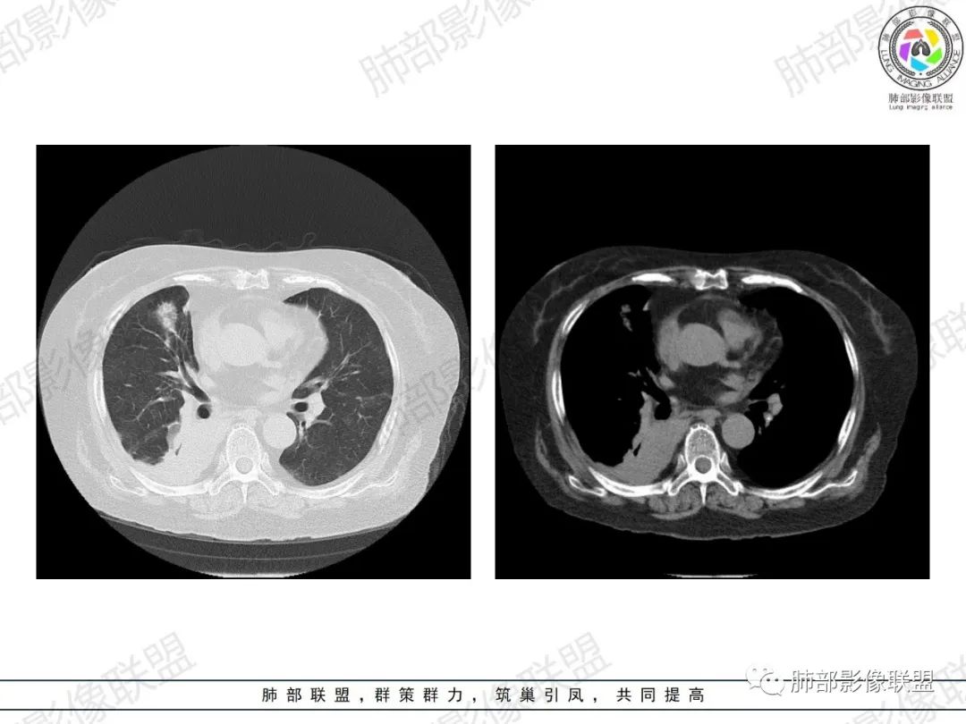 影像PPT - 【病例】肺部弥漫大B细胞淋巴瘤1例CT影像讨论-16 影像PPT - 【病例】肺部弥漫大B细胞淋巴瘤1例CT影像讨论-16