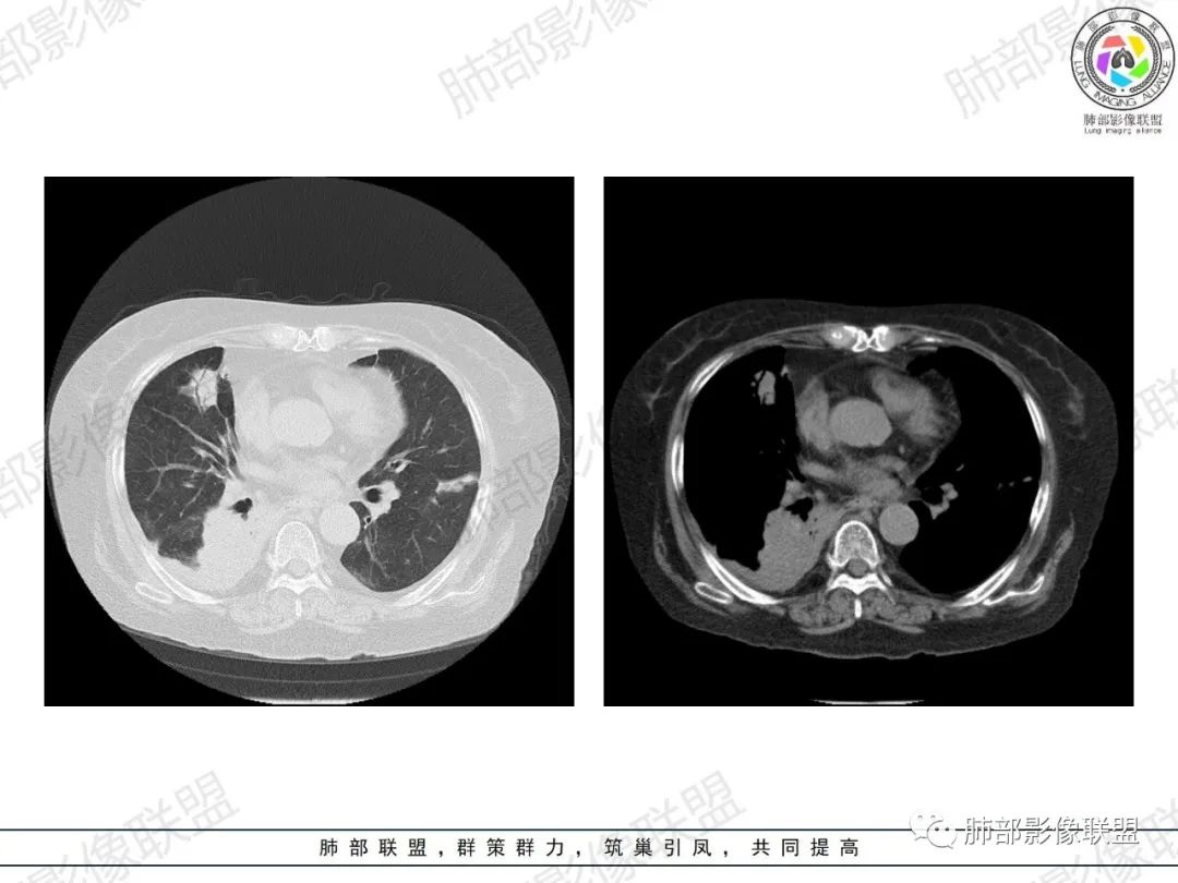 影像PPT - 【病例】肺部弥漫大B细胞淋巴瘤1例CT影像讨论-17 影像PPT - 【病例】肺部弥漫大B细胞淋巴瘤1例CT影像讨论-17