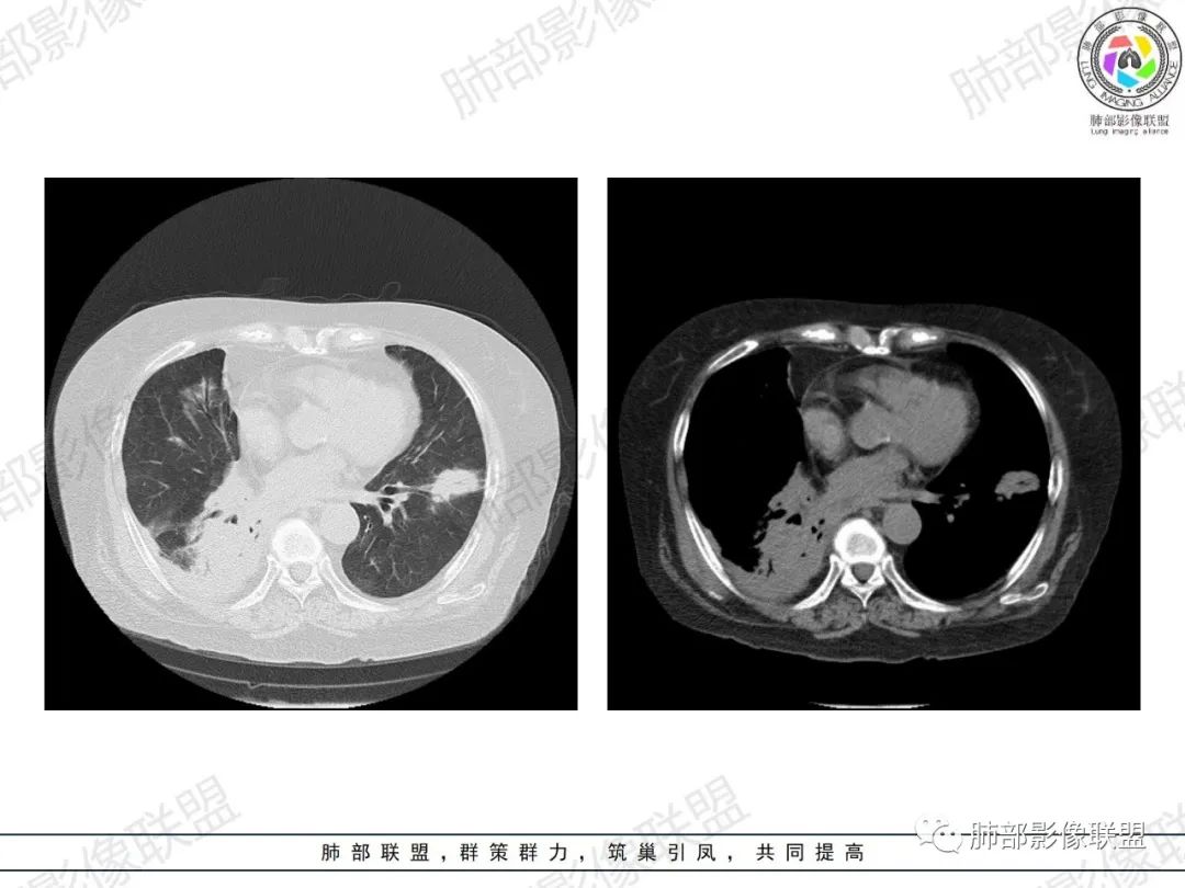 影像PPT - 【病例】肺部弥漫大B细胞淋巴瘤1例CT影像讨论-19 影像PPT - 【病例】肺部弥漫大B细胞淋巴瘤1例CT影像讨论-19