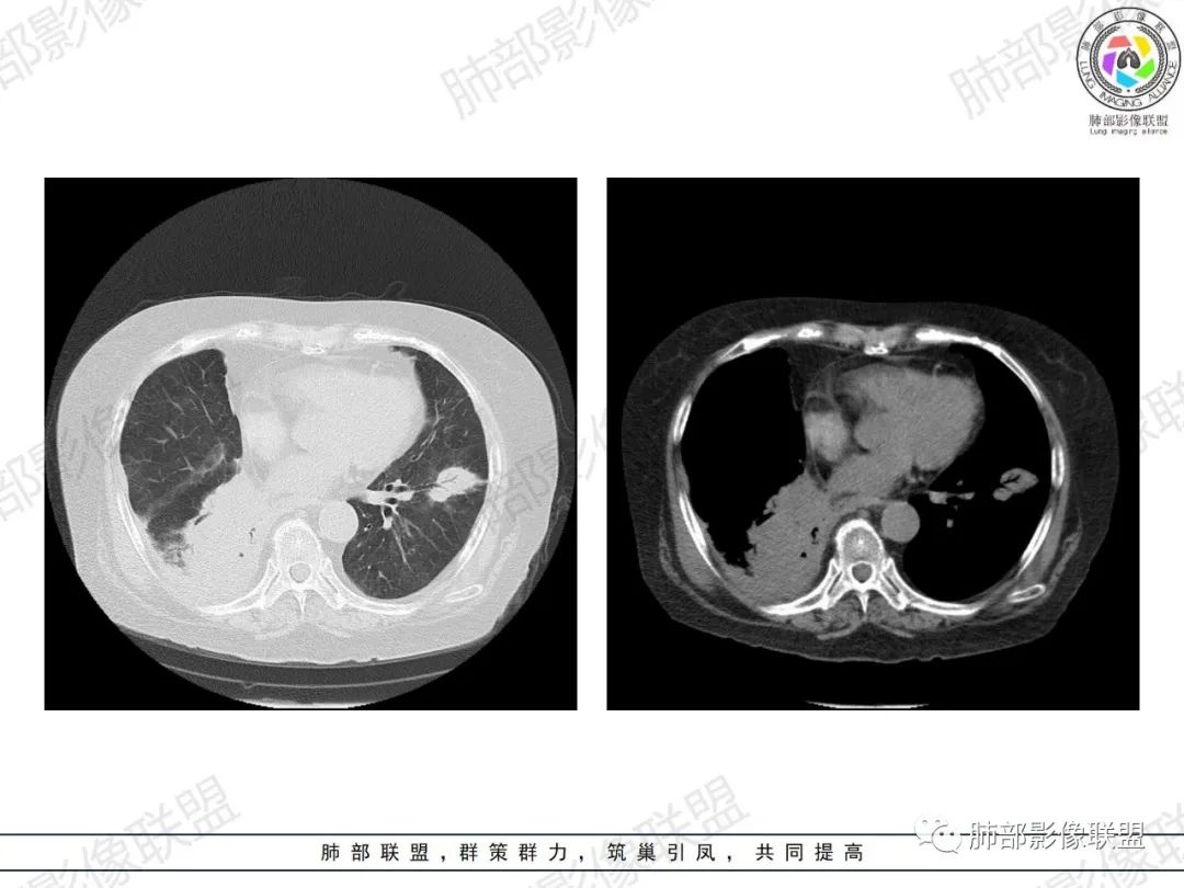 影像PPT - 【病例】肺部弥漫大B细胞淋巴瘤1例CT影像讨论-20 影像PPT - 【病例】肺部弥漫大B细胞淋巴瘤1例CT影像讨论-20