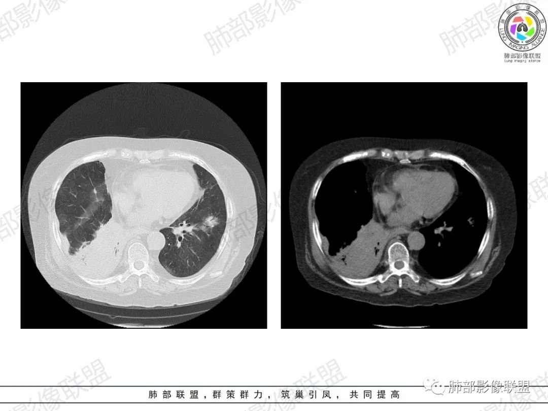 影像PPT - 【病例】肺部弥漫大B细胞淋巴瘤1例CT影像讨论-21 影像PPT - 【病例】肺部弥漫大B细胞淋巴瘤1例CT影像讨论-21