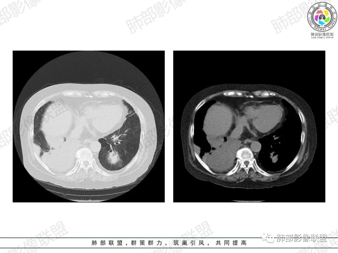 影像PPT - 【病例】肺部弥漫大B细胞淋巴瘤1例CT影像讨论-24 影像PPT - 【病例】肺部弥漫大B细胞淋巴瘤1例CT影像讨论-24