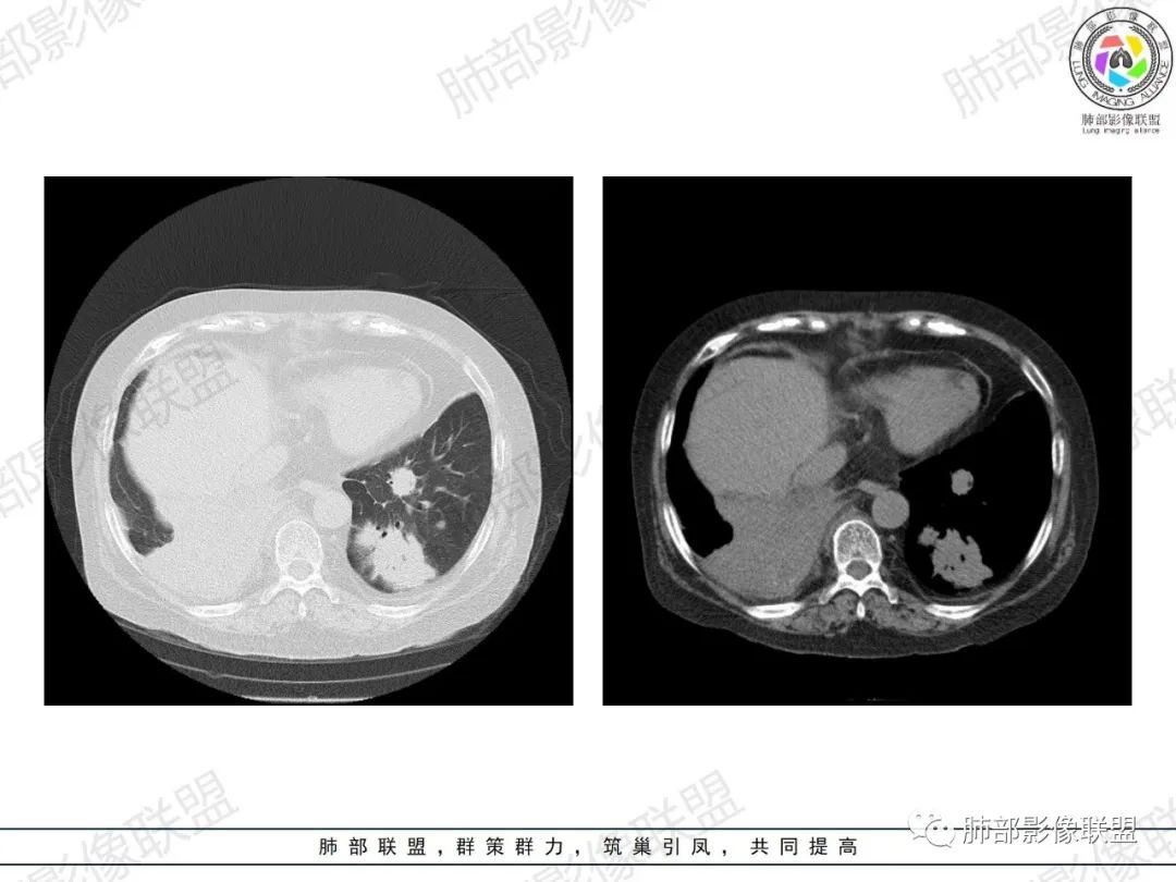 影像PPT - 【病例】肺部弥漫大B细胞淋巴瘤1例CT影像讨论-26 影像PPT - 【病例】肺部弥漫大B细胞淋巴瘤1例CT影像讨论-26