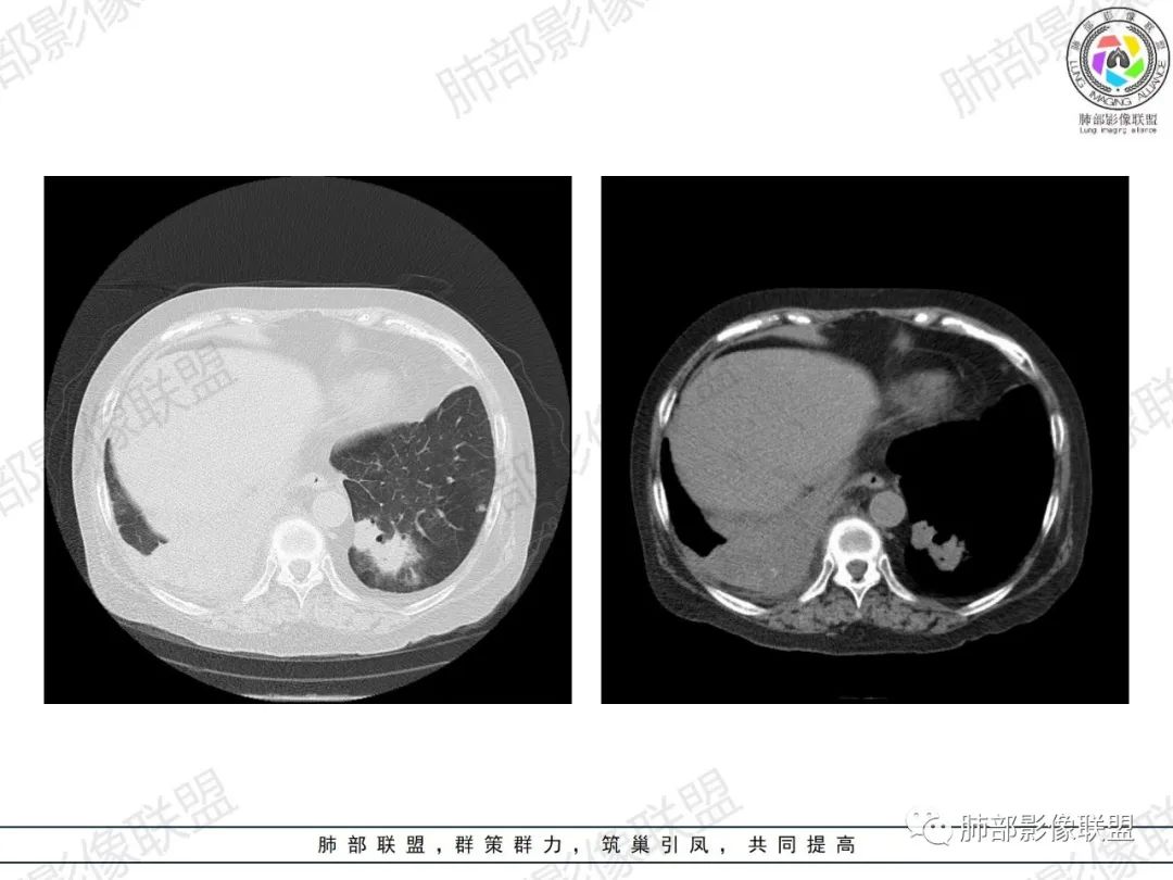影像PPT - 【病例】肺部弥漫大B细胞淋巴瘤1例CT影像讨论-28 影像PPT - 【病例】肺部弥漫大B细胞淋巴瘤1例CT影像讨论-28