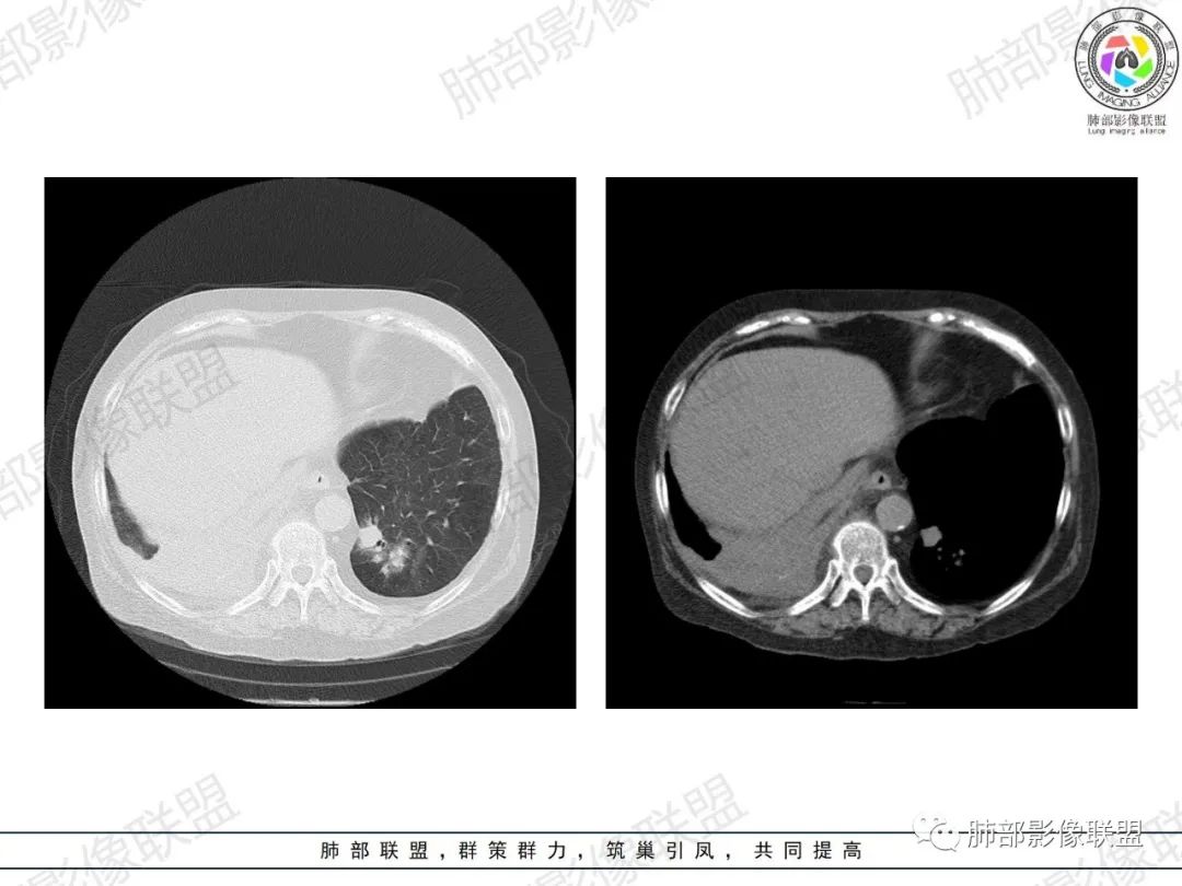 影像PPT - 【病例】肺部弥漫大B细胞淋巴瘤1例CT影像讨论-29 影像PPT - 【病例】肺部弥漫大B细胞淋巴瘤1例CT影像讨论-29