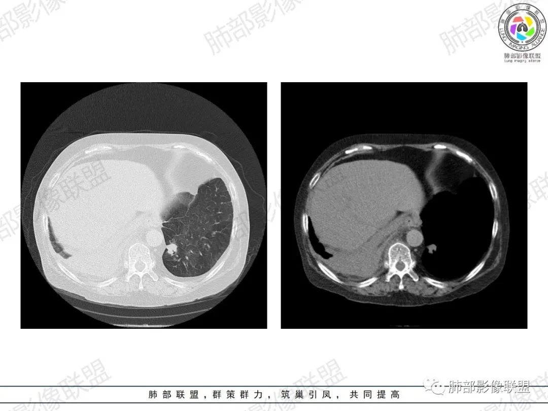 影像PPT - 【病例】肺部弥漫大B细胞淋巴瘤1例CT影像讨论-30 影像PPT - 【病例】肺部弥漫大B细胞淋巴瘤1例CT影像讨论-30