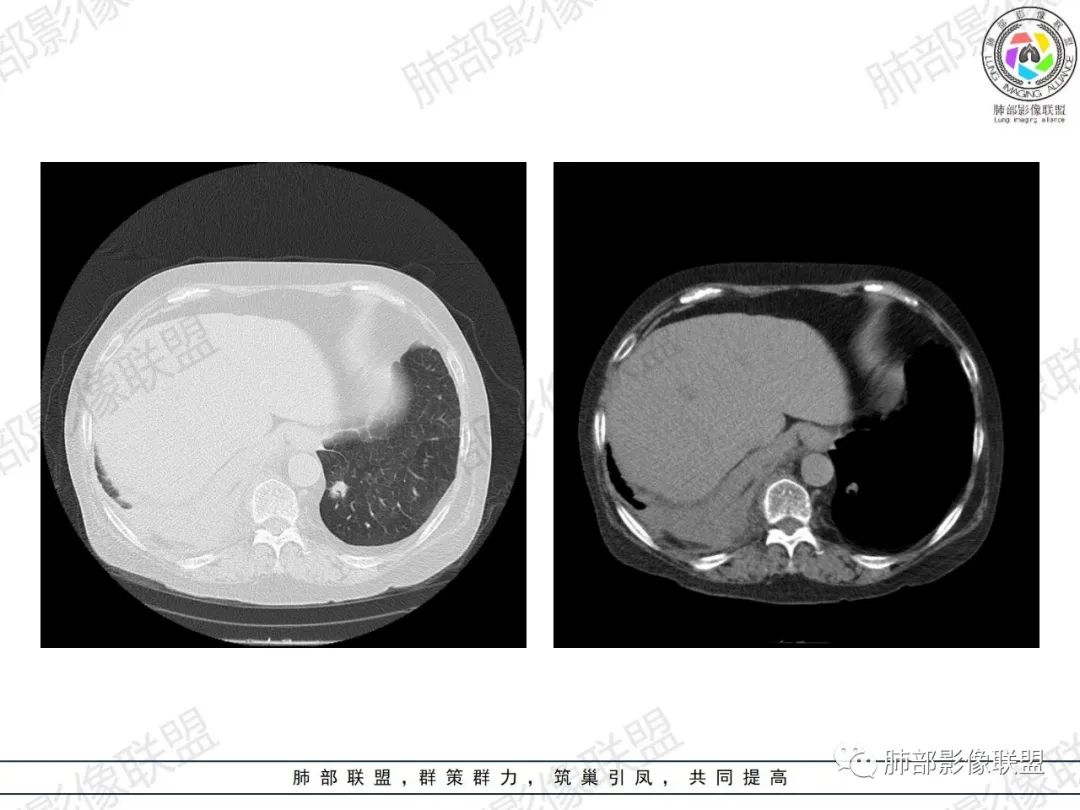 影像PPT - 【病例】肺部弥漫大B细胞淋巴瘤1例CT影像讨论-31 影像PPT - 【病例】肺部弥漫大B细胞淋巴瘤1例CT影像讨论-31