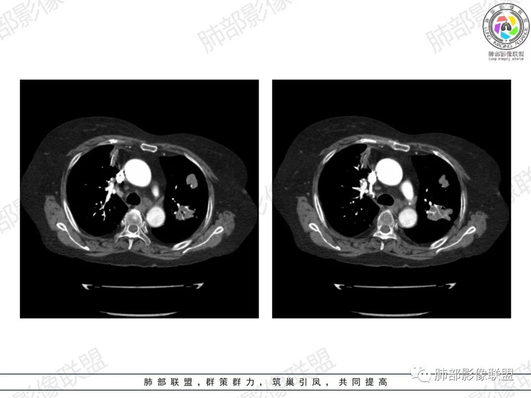 影像PPT - 【病例】肺部弥漫大B细胞淋巴瘤1例CT影像讨论-33 影像PPT - 【病例】肺部弥漫大B细胞淋巴瘤1例CT影像讨论-33