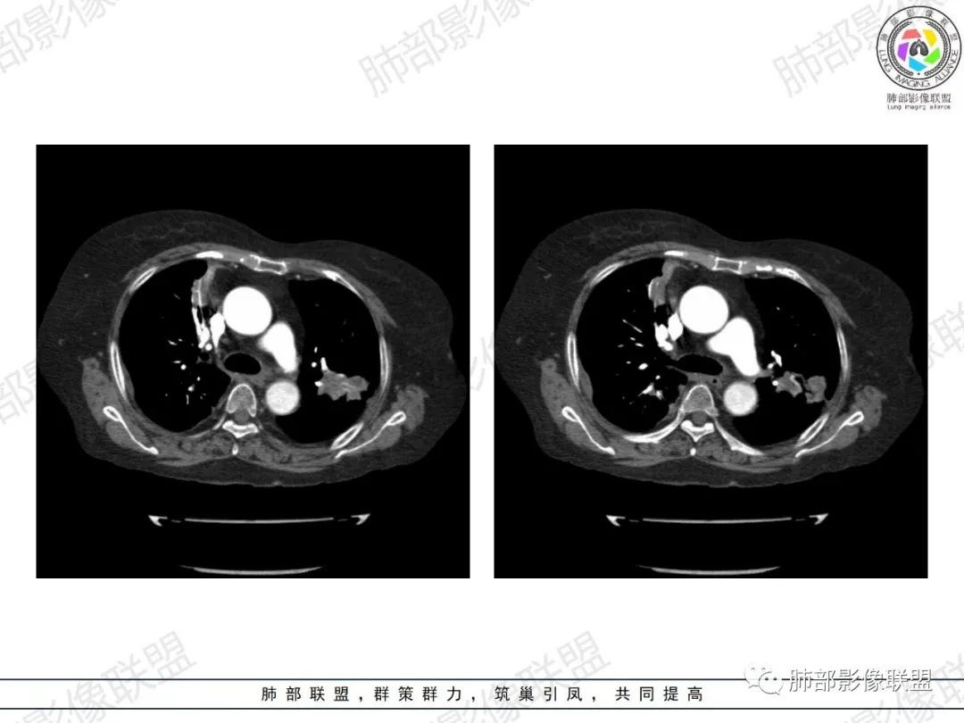 影像PPT - 【病例】肺部弥漫大B细胞淋巴瘤1例CT影像讨论-34 影像PPT - 【病例】肺部弥漫大B细胞淋巴瘤1例CT影像讨论-34