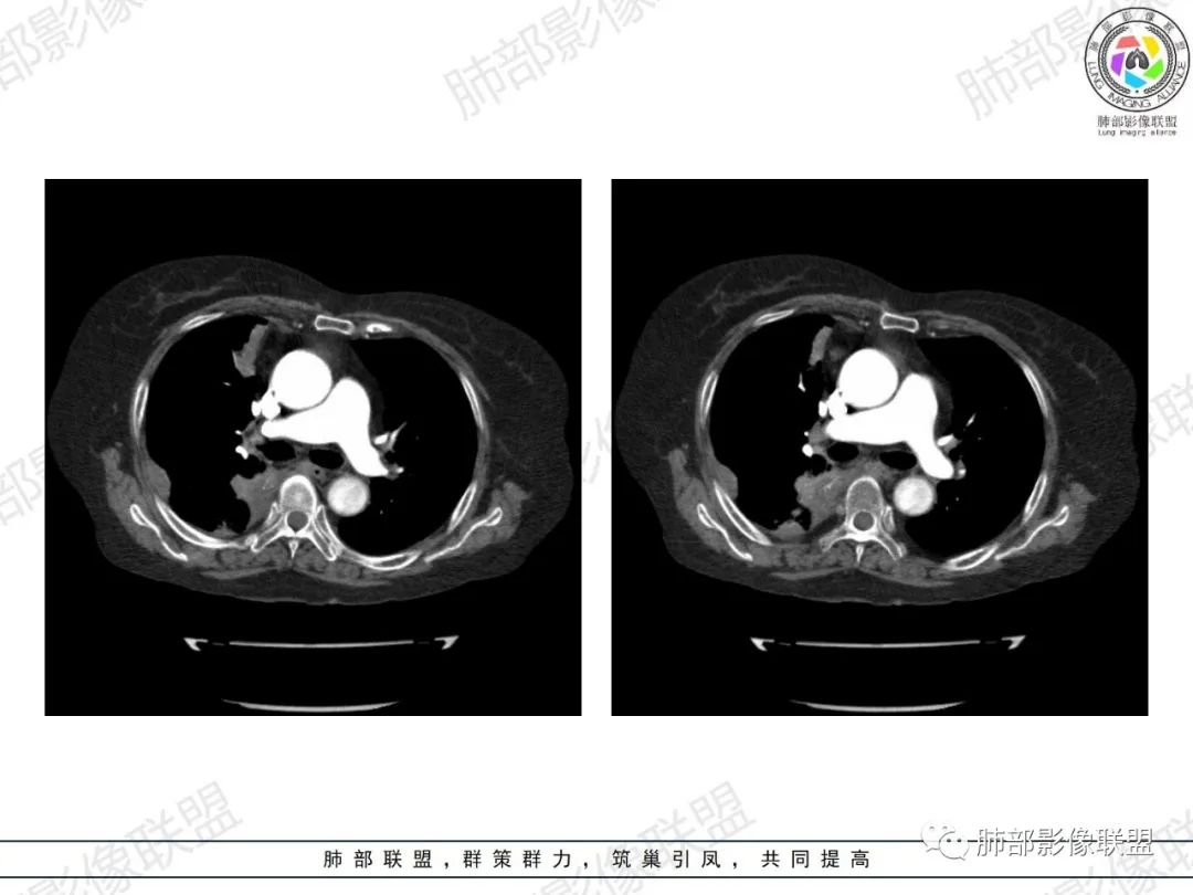 影像PPT - 【病例】肺部弥漫大B细胞淋巴瘤1例CT影像讨论-36 影像PPT - 【病例】肺部弥漫大B细胞淋巴瘤1例CT影像讨论-36