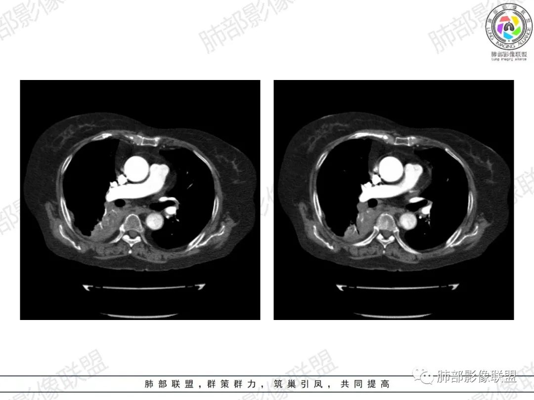 影像PPT - 【病例】肺部弥漫大B细胞淋巴瘤1例CT影像讨论-38 影像PPT - 【病例】肺部弥漫大B细胞淋巴瘤1例CT影像讨论-38