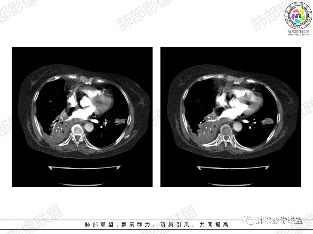 影像PPT - 【病例】肺部弥漫大B细胞淋巴瘤1例CT影像讨论-43 影像PPT - 【病例】肺部弥漫大B细胞淋巴瘤1例CT影像讨论-43